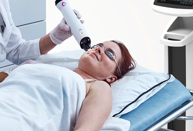 IPL-Behandlung mit Schutzbrille im Gesichtsbereich