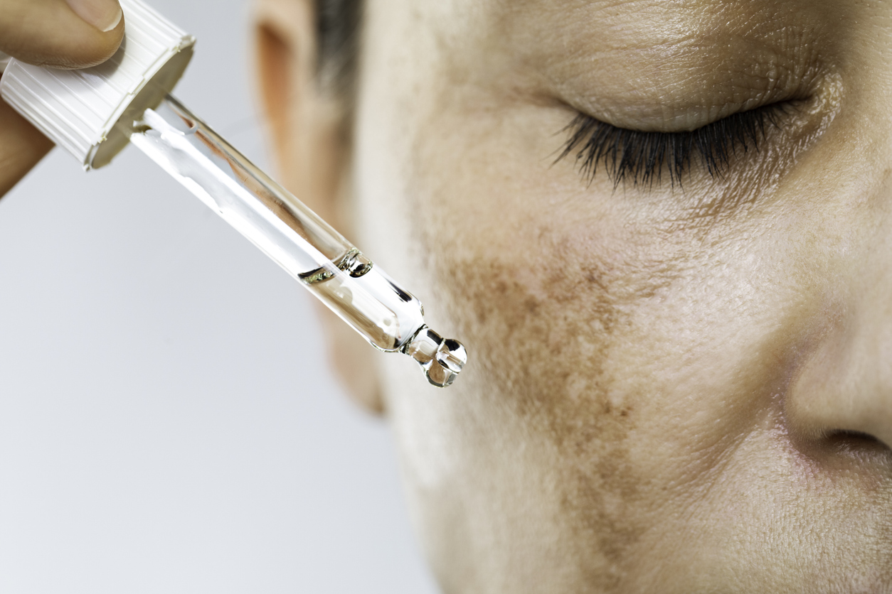 Pipette über der Haut mit Pigmentveränderungen